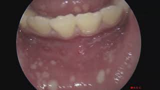 Severe Mouth and Throat Pain Caused By Herpes Infection [upl. by Okia5]