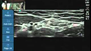 Ultrasound location of medial cutaneous nerve of forearm [upl. by Lekcar373]