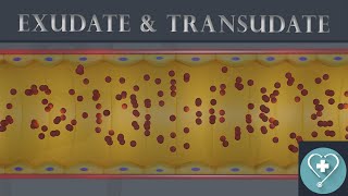 Exudate and Transudate  Introduction  Pathology [upl. by Marigolde982]