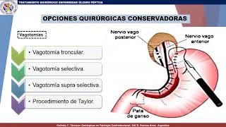 TRATAMIENTO QUIRURGICO ENFERMEDAD ULCERO PEPTICA [upl. by Ludewig48]