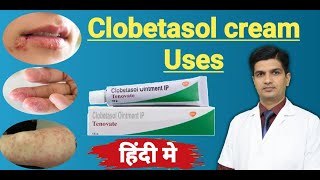 Clobetasol Propionate cream uses  Tenovate cream Uses in hindi [upl. by Moina450]