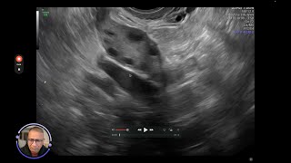 antral follicle count [upl. by Neehs263]