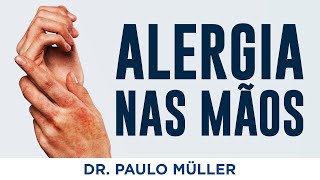 Alergia Nas Mãos – Dr Paulo Müller Dermatologista [upl. by Epoillac]