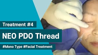 NeoGenesis Thread Series PDO Mono Type Facial Treatment [upl. by Devan]