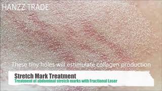 CO2 Fractional Laser Stretch Marks Treatment [upl. by Eardnoed464]