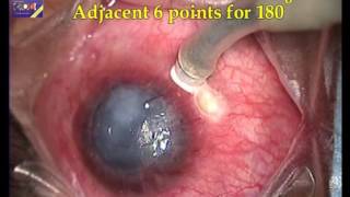 CYCLOCRYOPEXY  treatment of glaucoma  CCT  destroy the ciliary body [upl. by Rentsch356]