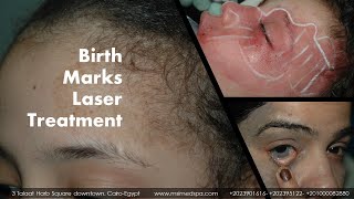 Birthmarks Treatment [upl. by Arais]