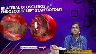 BILATERAL OTOSCLEROSIS ENDOSCOPIC LEFT STAPEDOTOMY  DRSHAKUNTALA GHOSH  SRI RAMA ENT CARE CENTER [upl. by Arbmahs]