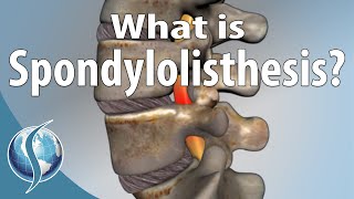 What Is Spondylolisthesis [upl. by Schultz50]