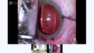 Live ICL Surgery  Dr Robert Rivera from Hoopes Visionmp4 [upl. by Gutow]