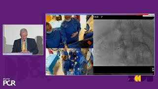 The turning point in hypertension care Symplicity Spyral renal denervation in practice  EuroPCR [upl. by Jahdiel]