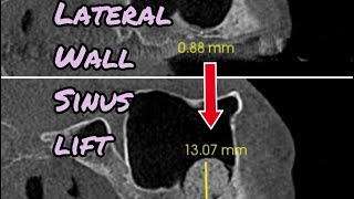 Lateral Wall Sinus Lift StepbyStep [upl. by Yenahc]