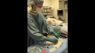 Lumbar Epidural Placement in an Child [upl. by Dust45]