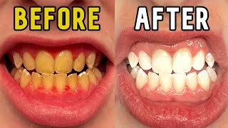 How I Whitened My Teeth in 14 Days [upl. by Glenda]