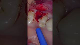 Transalveolar Sinus Elevation with Roll Flap Technique [upl. by Susanna443]