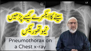 Pneumothorax on a Chest x ray  Chest xray interpretation in Urdu  Hindi [upl. by Inaffit]