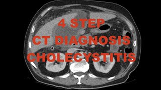 4 step diagnosis  Acute Cholecystitis on CT scan  case review with differential diagnoses [upl. by Roydd449]