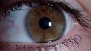 Nistagmus rotatorio  Rotary Nystagmus [upl. by Spense]