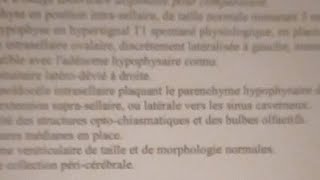 Hyperprolactinémie adénome hypophysaire Dostinex Parlodel  bilan médical et FAQ [upl. by Thinia]