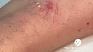 Sclerotherapy Leg Vein Treatment  The Laser and Skin Clinic [upl. by Jala]