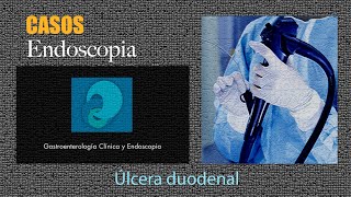 Úlcera duodenal [upl. by Helbonia]