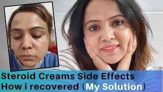 How I Recovered From Steroid cream Side Effects  My Experience  Stop using Hydroquinone [upl. by Hance953]