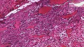 Histopathology Appendix Periappendiceal abscess [upl. by Parthinia187]