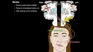 Bells Palsy and Stroke [upl. by Bury]