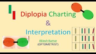 Diplopia Charting and Interpretation [upl. by Erdne436]