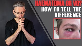 Haematoma Or Vascular Occlusion How To Tell The Difference Aesthetics Mastery Show [upl. by Tserof381]