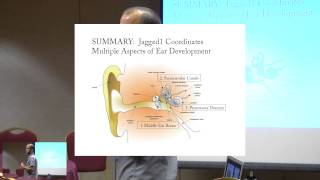 Hear loss in patients with Alagille Syndrome [upl. by Lambard]