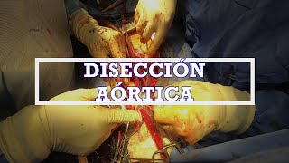 Disección Aórtica  Parte 1 [upl. by Lirrehs]