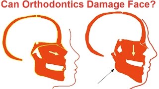 Can Orthodontics Damage Faces by Prof John Mew [upl. by Savihc433]