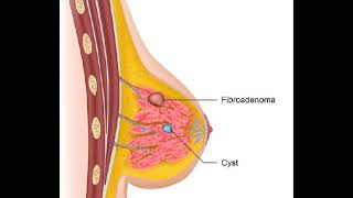 FibroadenomaSignSymptomstreatment plan [upl. by Epolenep]
