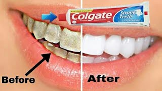 colgate कोलगेट का ये छोटा सा उपाय आपके गन्दे पीले दांत को 2 मिनट में चमका देगा [upl. by Nissie]