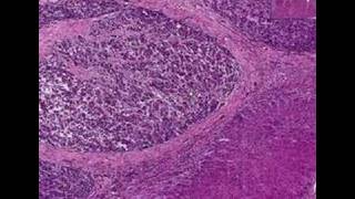 Histopathology LiverHepatocellular carcinoma in cirrhosis [upl. by Ylecara369]