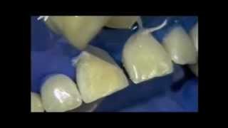 Dental Bonding  Long Island Dentist [upl. by Leander764]