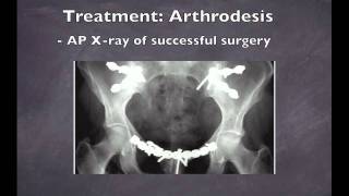 Osteitis Pubis  Treatment Methods [upl. by Schach]