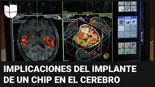 ¿Un chip en el cerebro Estas son las preocupaciones éticas que hay con los implantes de Neuralink [upl. by Emlynn]