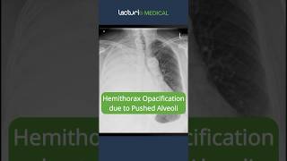 Hemithorax Opacification Pushed Alveoli Explained 🩺 ChestXray Radiology USMLE [upl. by Elatnahs485]