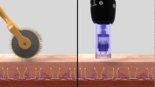 DERMAPEN SISTEMA DE REMODELACIÓN TISULAR [upl. by Klapp349]