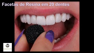 20 Facetas de Resina para você personalizar seus dentes [upl. by Huskamp851]