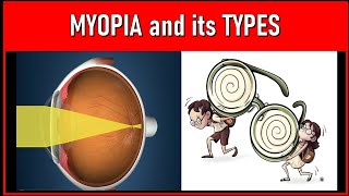 Unveiling the Secrets of Myopia Exploring Various Types and Causes [upl. by Spence597]