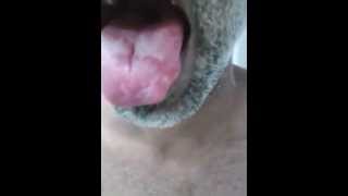 Geographic tongue [upl. by Leasa]