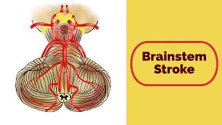 Brainstem Stroke Syndromes [upl. by Rives]