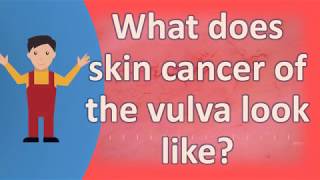 What does skin cancer of the vulva look like  Top Health FAQS [upl. by Leipzig]