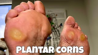 CORN REMOVAL FROM FEET  EXTREMELY SATISFYING [upl. by Altaf]