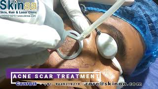 Acne Scar Laser Removal Treatment in Jaipur with Fractional Co2 FDA Approved Laser Skinaa Clinic [upl. by Jerrylee352]