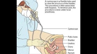 Video Cystoscopy Actual Procedure ENG SUB [upl. by Nyvlem845]