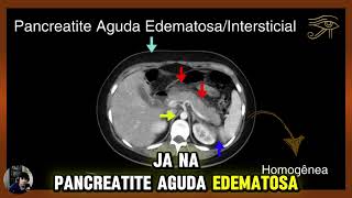 Achados Tomográficos na Pancreatite Aguda Edematosa [upl. by Misak626]